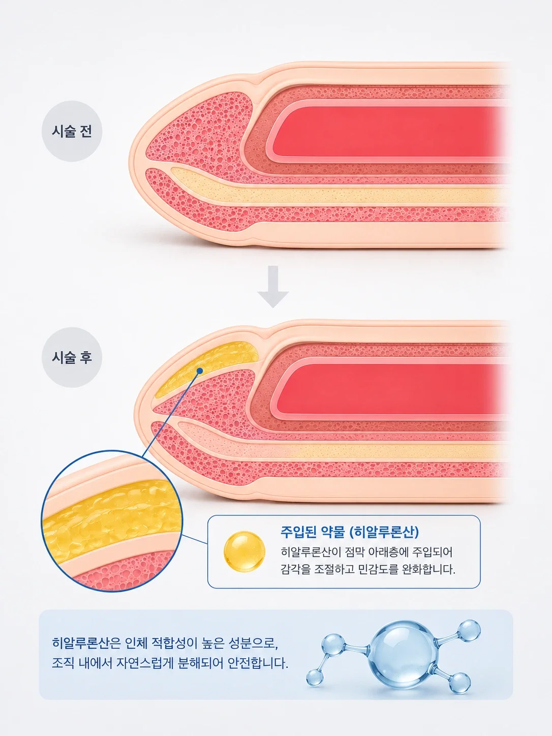 귀두 약물 주입술