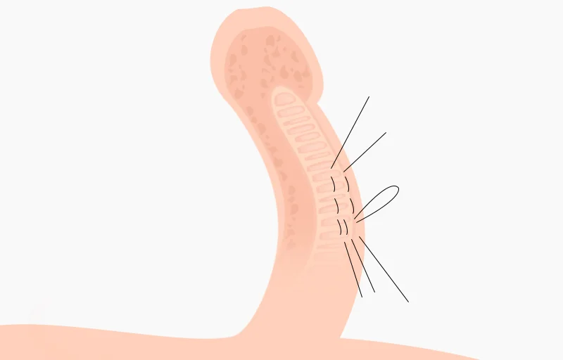 단순 봉합법